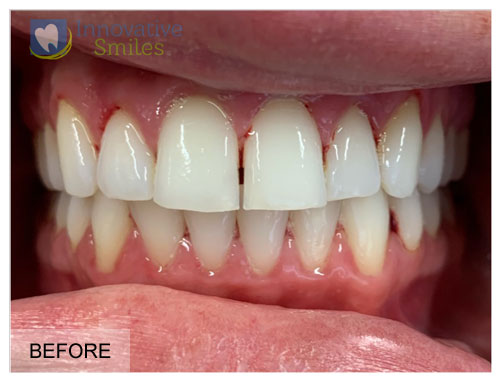 Cosmetic Bonding Before