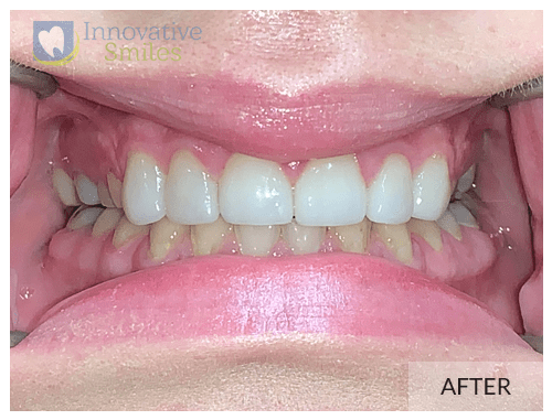 Veneers After