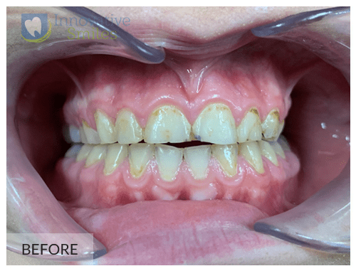 Veneers Before