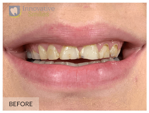 Veneers Before